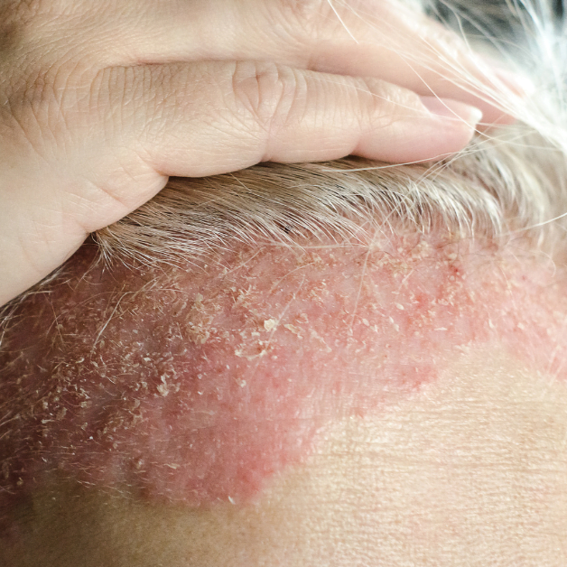 Psoriasis Care