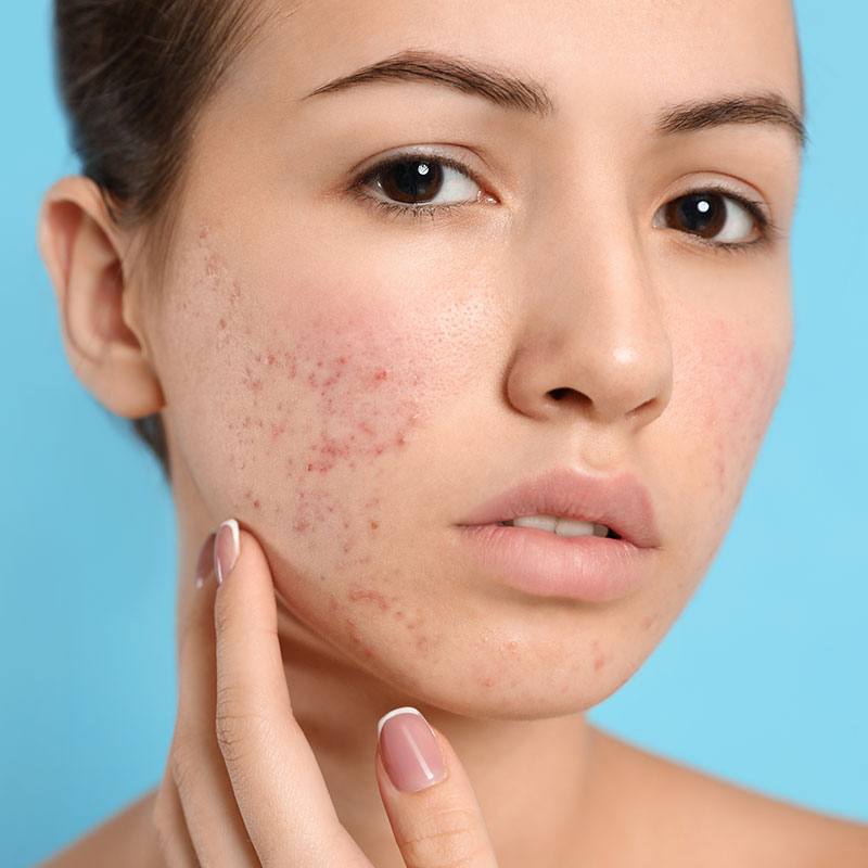 General Skin Diseases