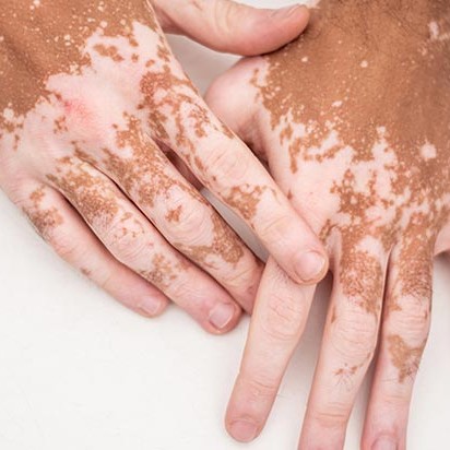 Vitiligo & Pigmentary Disorders