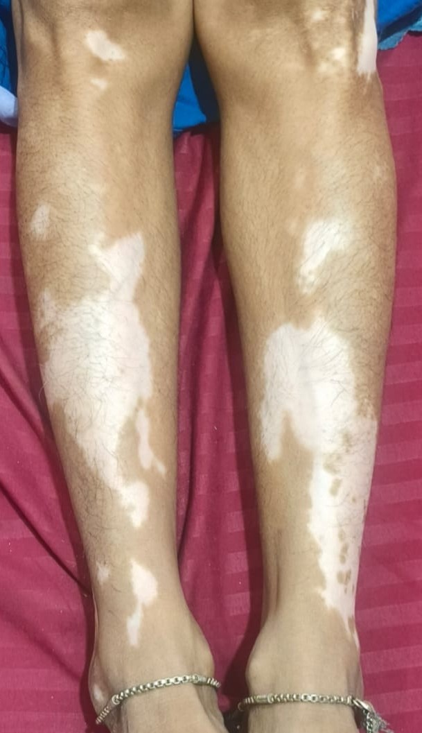 Before - Amelia: Precision Pigment Correction.
